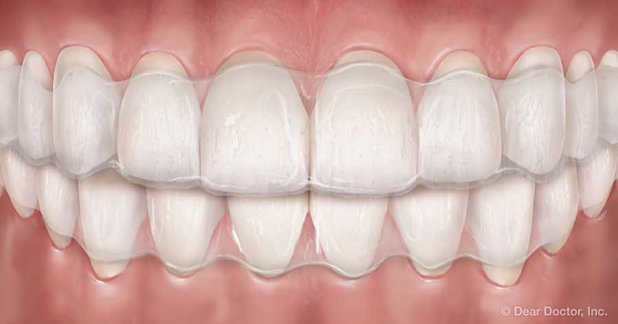 Clear aligners