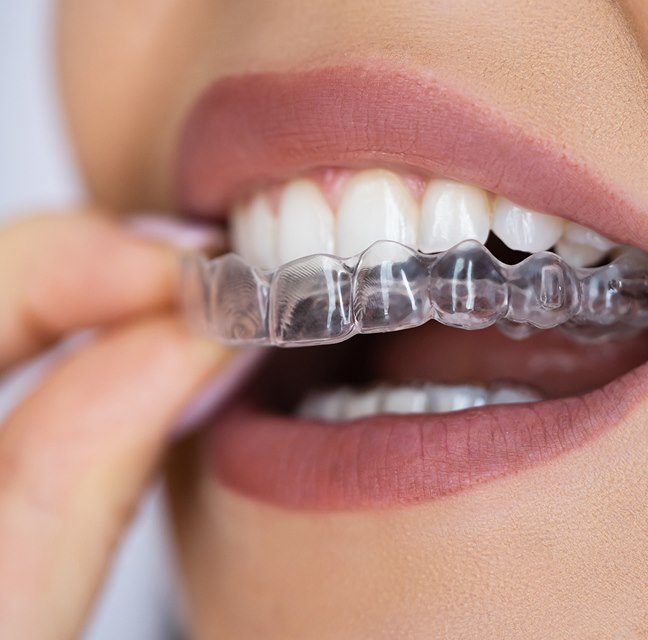 How Invisalign Treatment Works