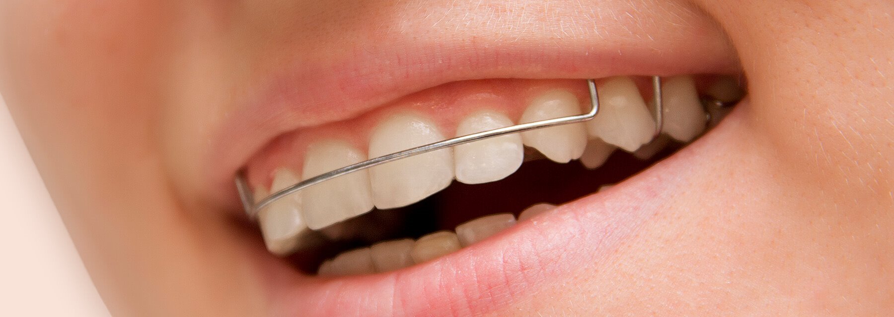 Braces Facility in Alameda US