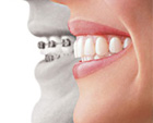 Invisalign®