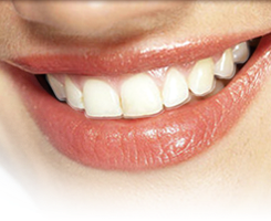 Invisalign aligners