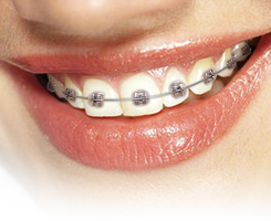 Metal braces