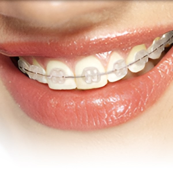 Ceramic Braces - Alameda Orthodontics, Alameda US