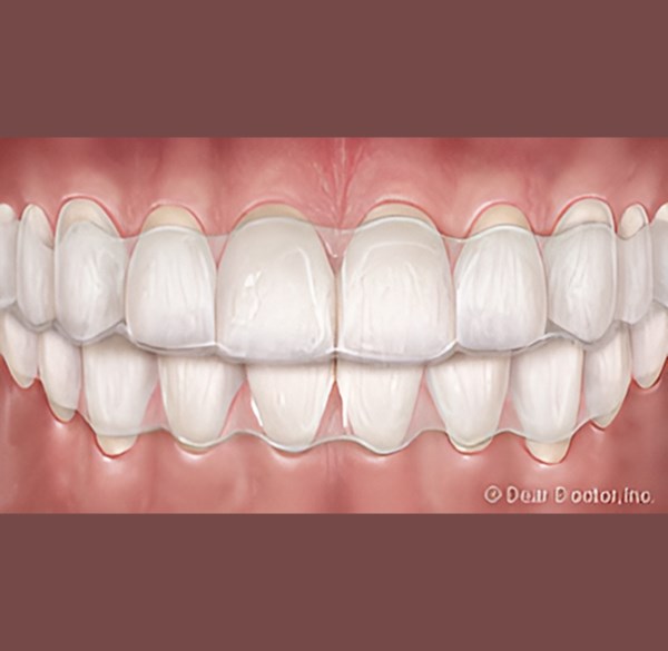Clear Aligners - Alameda Orthodontics, Alameda US