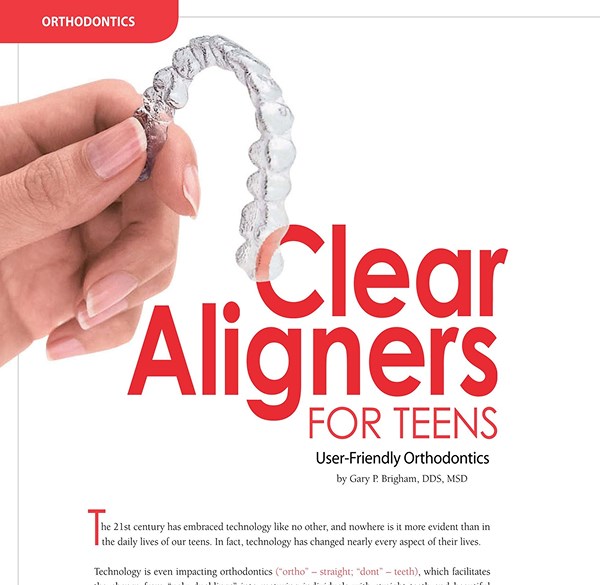 Clear Aligners for Teenagers