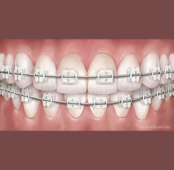Clear Braces - Alameda Orthodontics, Alameda US