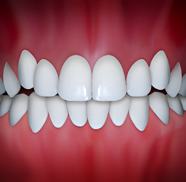 Crowding Treatment by Alameda Orthodontics, Alameda US