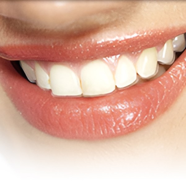 Invisalign® - Alameda Orthodontics, Alameda US