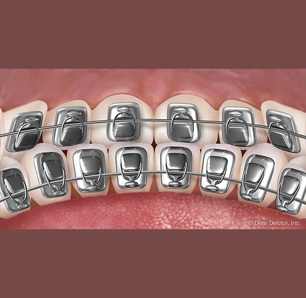 Lingual Braces - Alameda Orthodontics, Alameda US