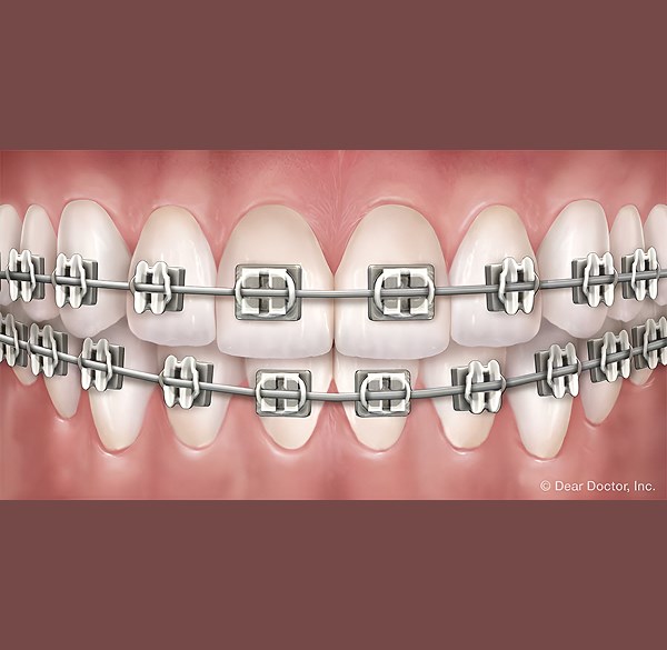 Metal Braces - Alameda Orthodontics, Alameda US