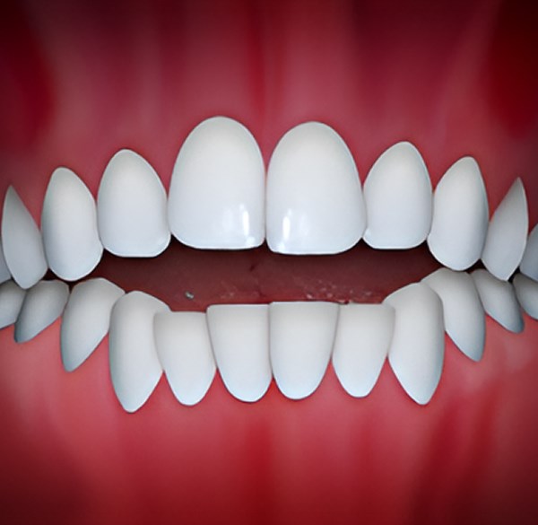 Openbite Treatment by Alameda Orthodontics, Alameda US