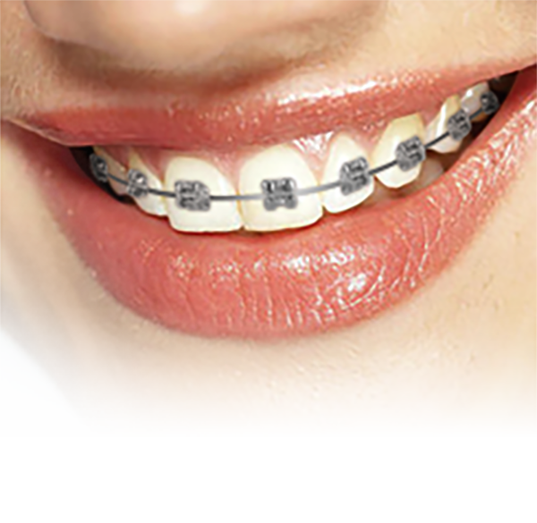Self-ligating braces