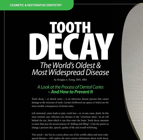 Tooth Decay — A Preventable Disease